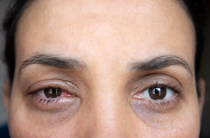 irritated eye due to an infection