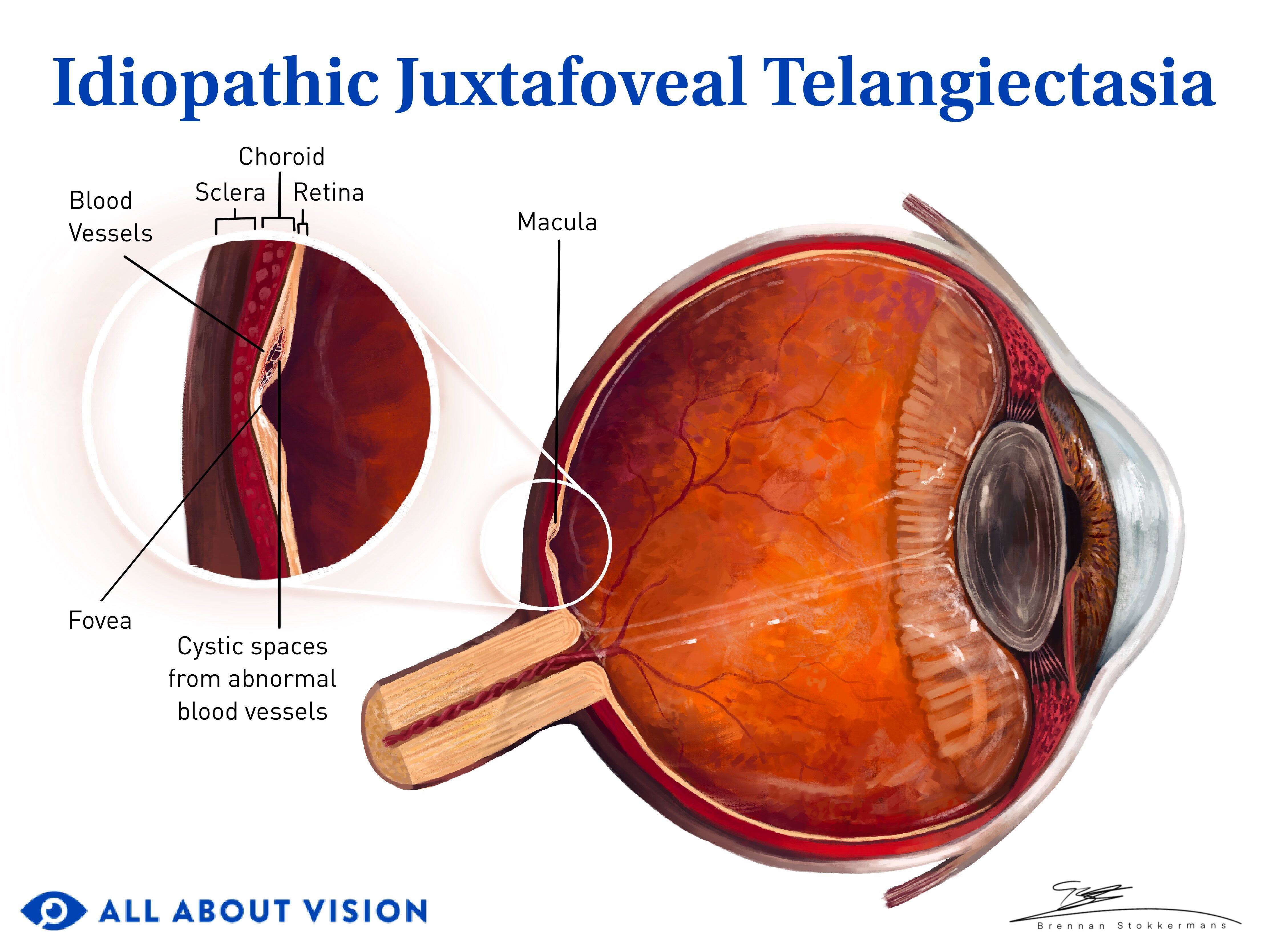 Person struggling with vision, sitting at a work desk.