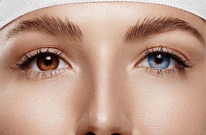 mujer con una cirugía de cambio de color de ojos con un ojo azul y un ojo marrón