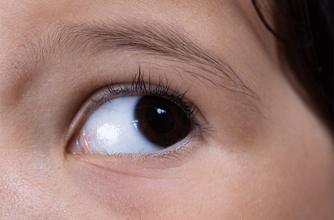 closeup do olho de uma criança com aniridia