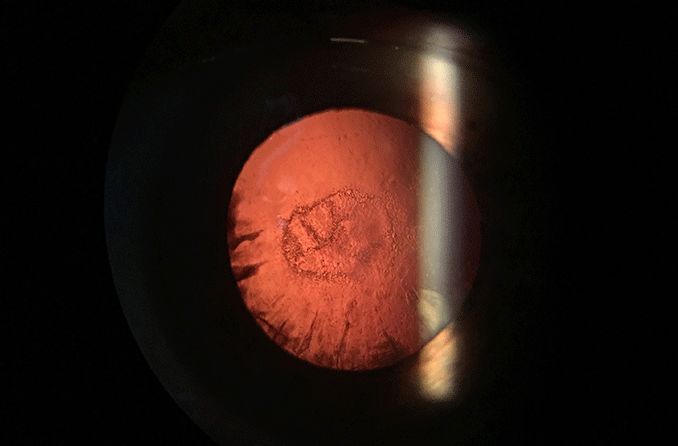 posterior subcapsular cataract