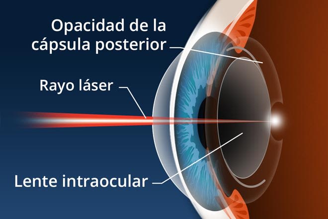 Lentes reticulares: ¿Cuántos niveles de mejora de la vista puedes esperar?