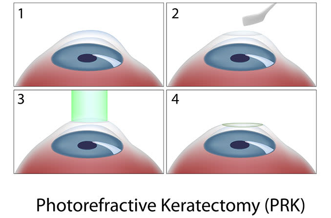 illustration of how prk laser surgery works