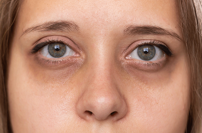 10 Natural Ways To Get Rid Of Bags Under The Eyes  TheHealthSitecom