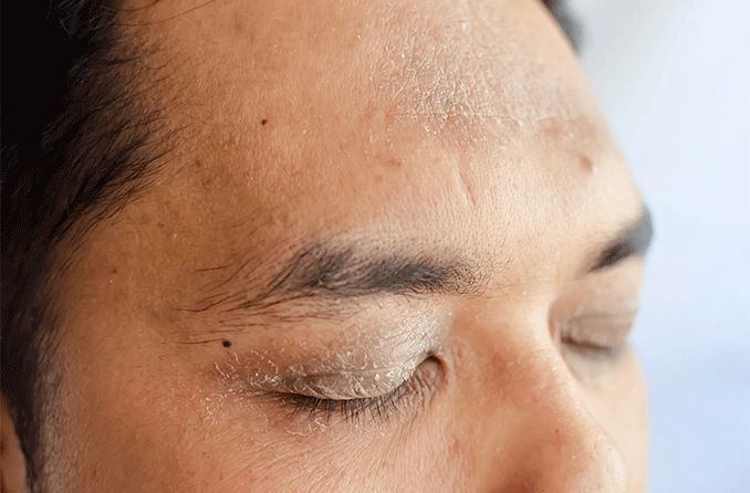 man with eyelid eczema