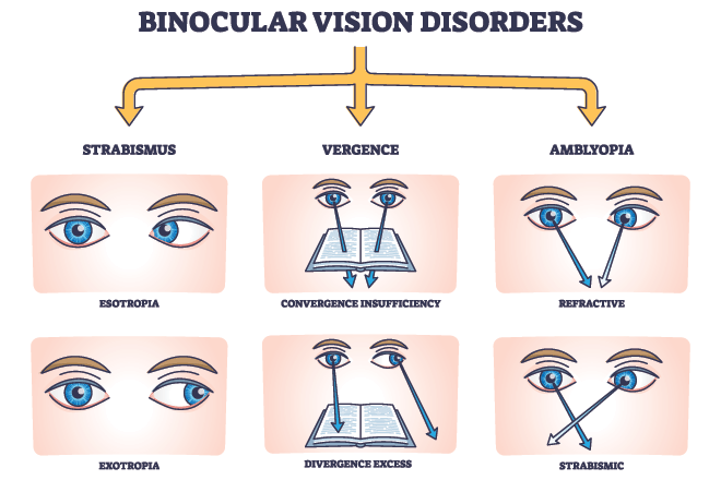 What Is Binocular Vision (Eye Teaming)?