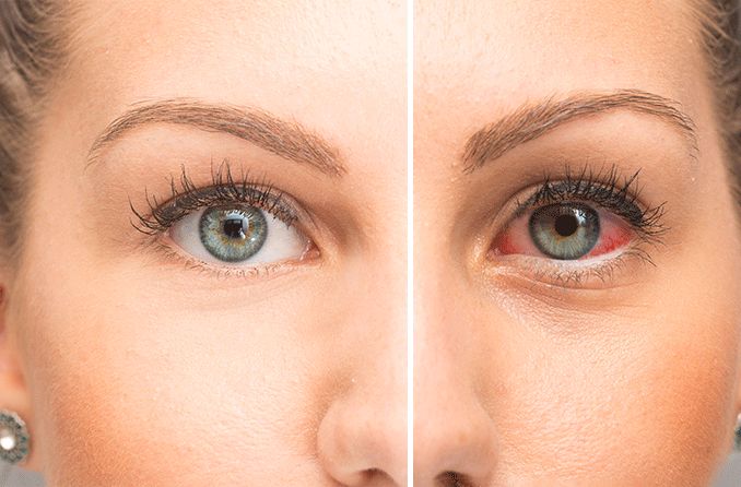 Get Rid of Puffy Eyes for Good with Dr. Berg's Proven Techniques 