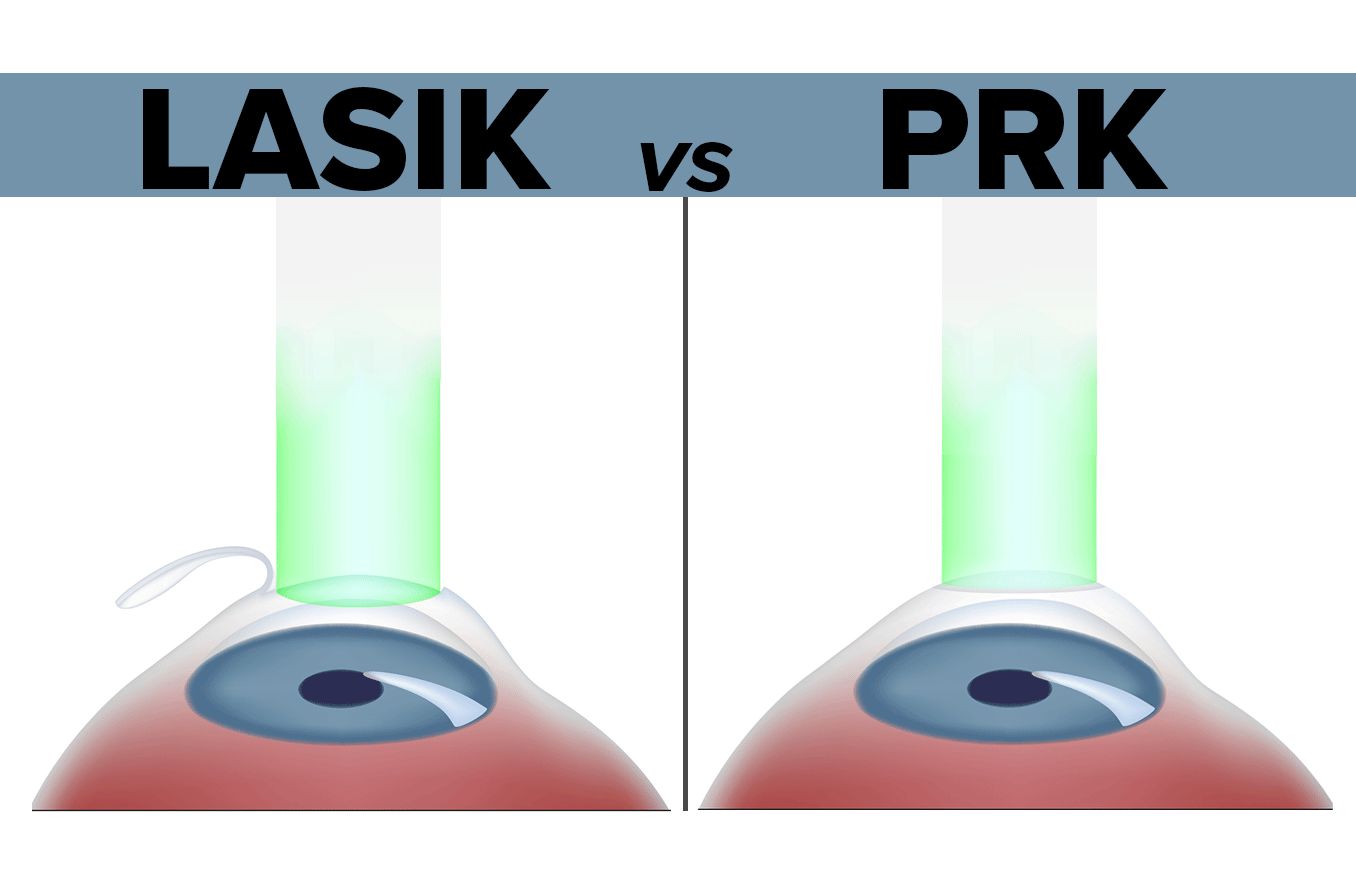 PRK vs. LASIK Cost, Differences, Pros and Cons