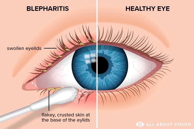 Blepharitis (Eyelid Inflammation): Symptoms, Causes and Treatment