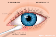 Lower Eyelid Infection Lower Eyelid Infection