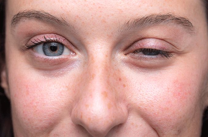 woman with ocular myasthenia gravis
