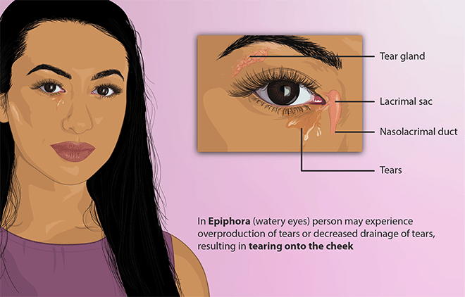 Eye Discharge: Causes, Types and Treatment