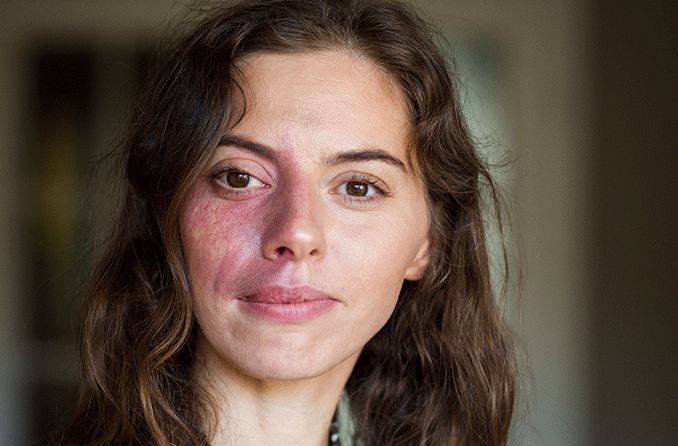 woman with Sturge-weber syndrome who has a port-wine stain over one side of her face and eye area