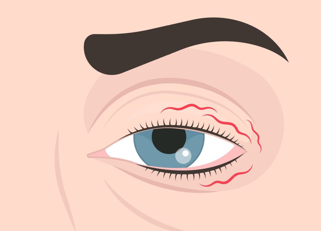 Representación de una persona con un ojo crispado