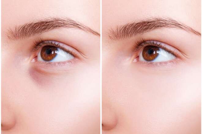 Tear Trough Filler Procedure Cost Before And After   Filler Before And After 