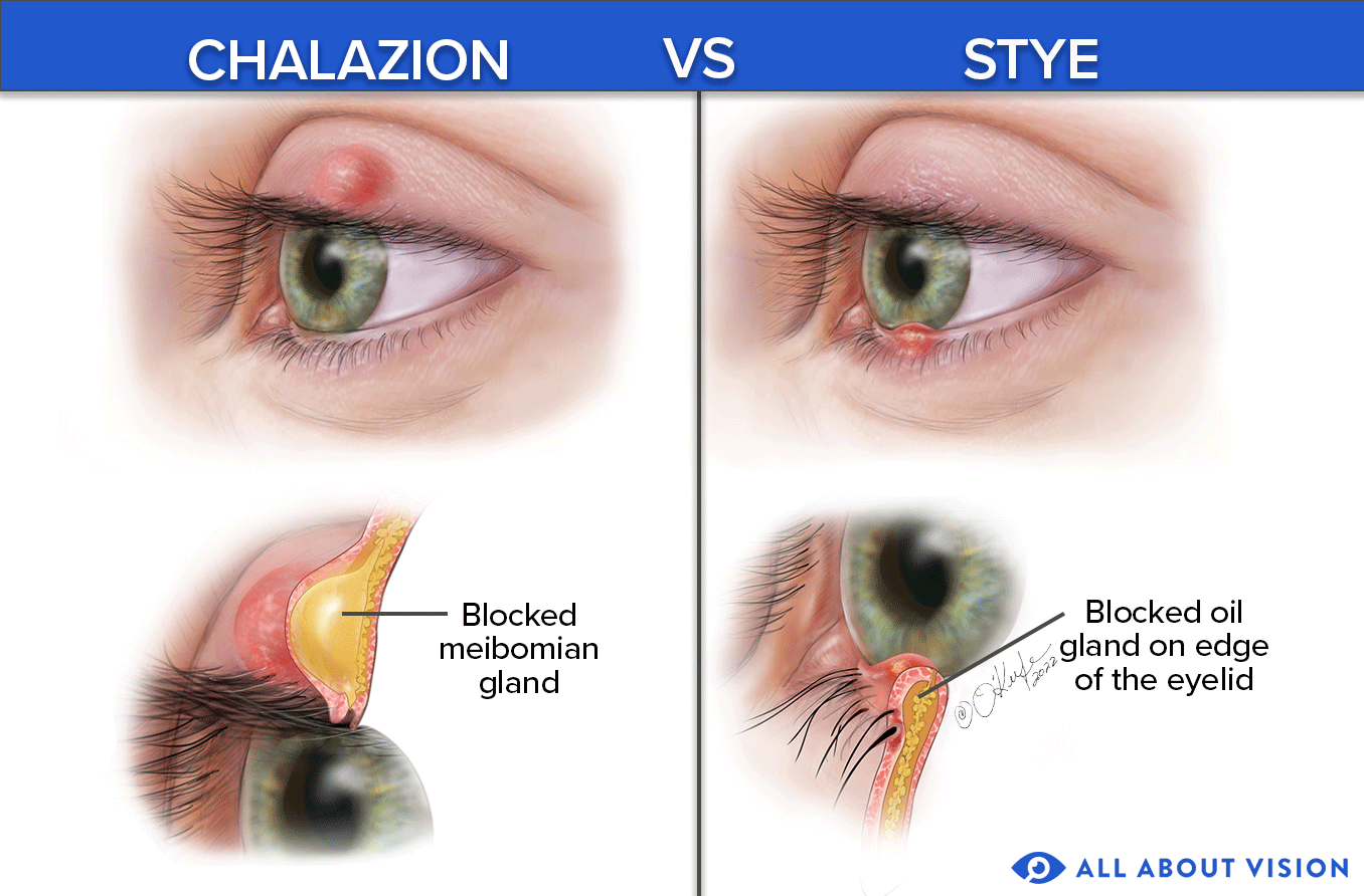 soft bump on eyelid