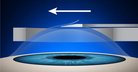 illustration of first step of epi-LASIK procedure