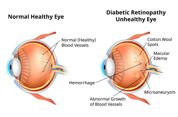 Diabetic eye disease How it can lead to vision loss