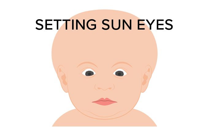 illustration of an infant with setting sun eyes