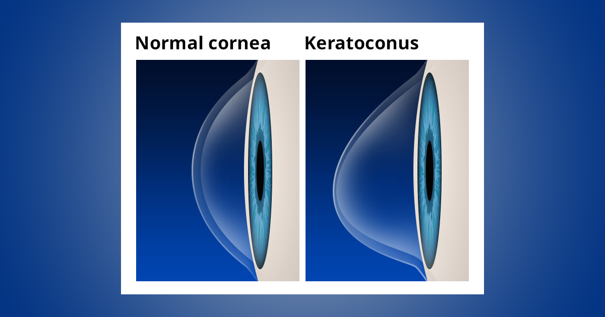 Keratoconus Causes, Symptoms And Treatment | All About Vision