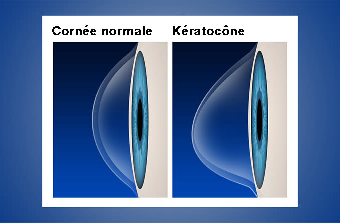 Cornée normale vs kératocône