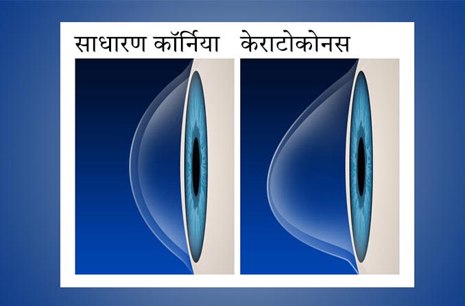 सामान्य कॉर्निया बनाम केराटोकोनस