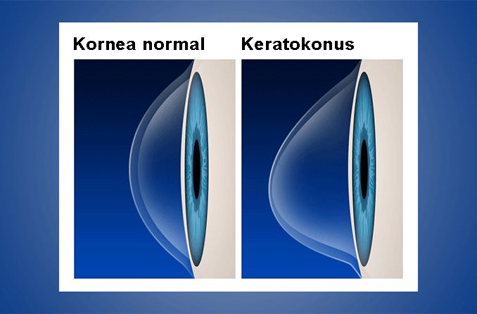 Kornea normal vs. keratokonus