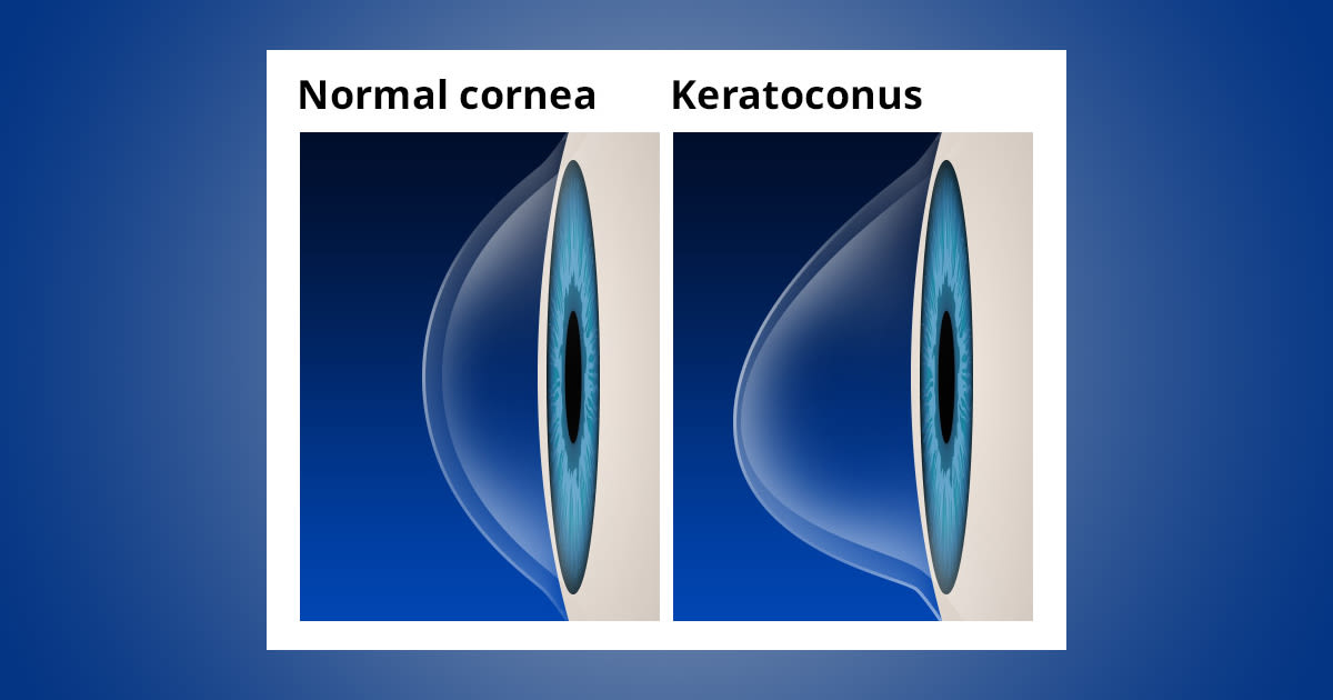 Normal cornea vs. keratoconus
