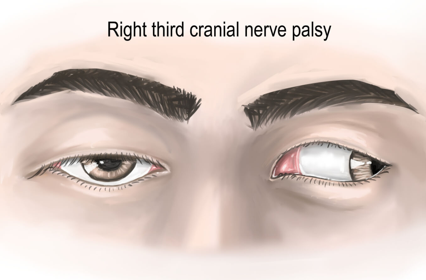 Microvascular Cranial Nerve Palsy An T M   Third Cranial Nerve Palsy Hero 