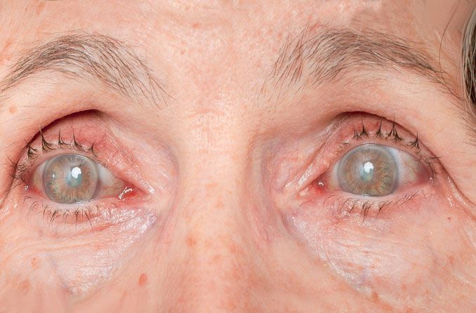 Elderly woman suffering symptoms of diabetic retinopathy