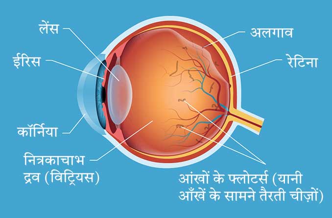 नेत्रों के भीतर विटेचर्स और फ्लोटर्स