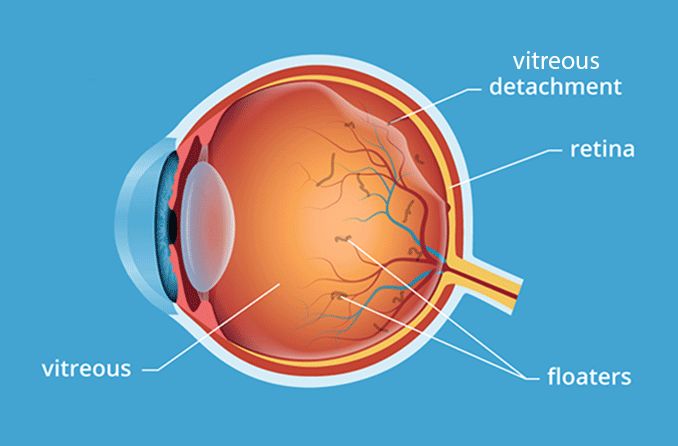 Vitreous detachment and floaters within the eye