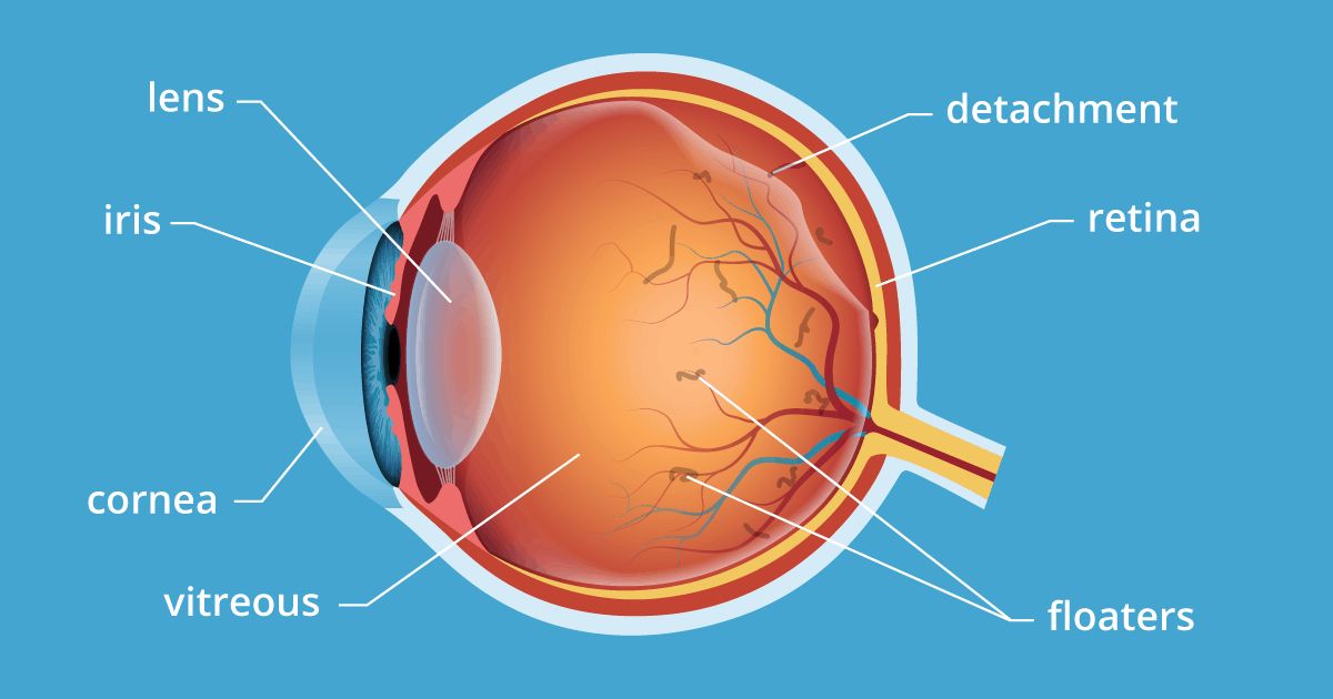 Vitreous detachment and floaters within the eye