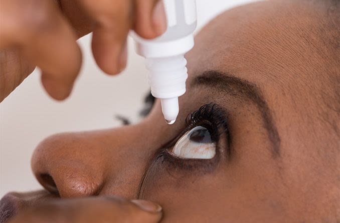 Frau verwendet Augentropfen, um ihre Augen aufzuhellen
