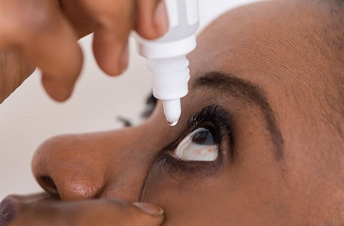 mujer usando gotas para los ojos para ayudar a blanquear sus ojos