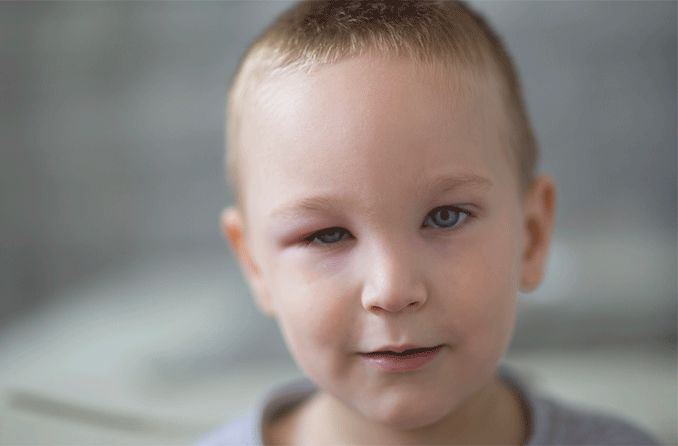 young boy with a swollen eyelid