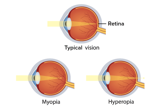 Eye difference?