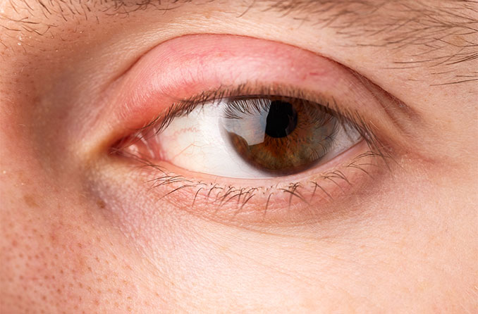 Swollen eyelids FAQs All About Vision