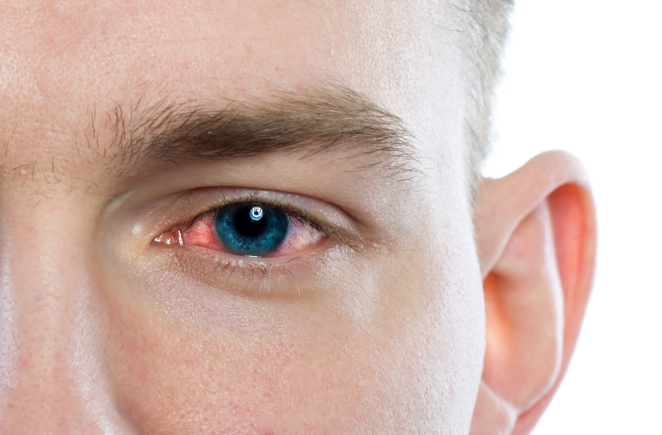 Close-up of person's red eye. Conjunctivitis or irritation of sensitive eyes.