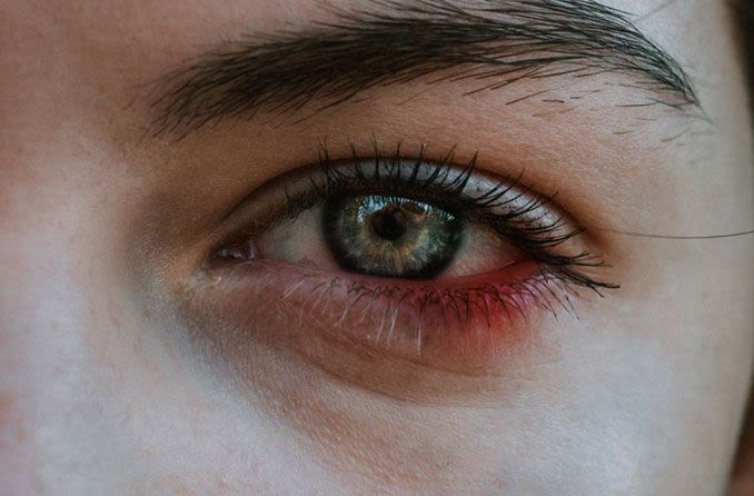 Blepharitis infections in the eyelid 