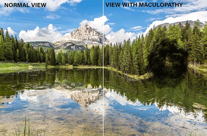 side by side mountain view of normal vision vs vision with maculopathy