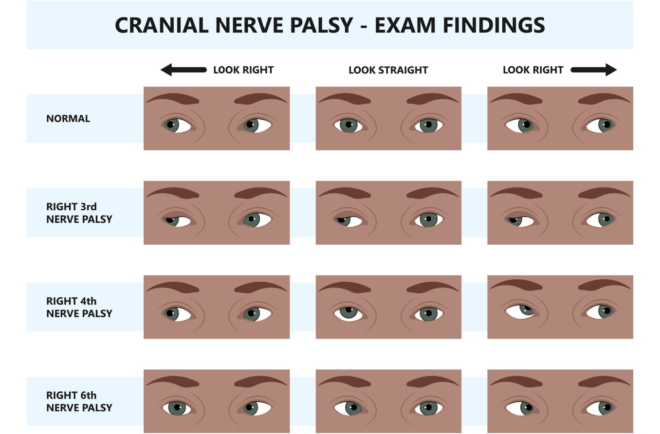 Cranial Nerve Palsy CN III IV VI VII Palsy   Cranial Nerve Palsy Hero 