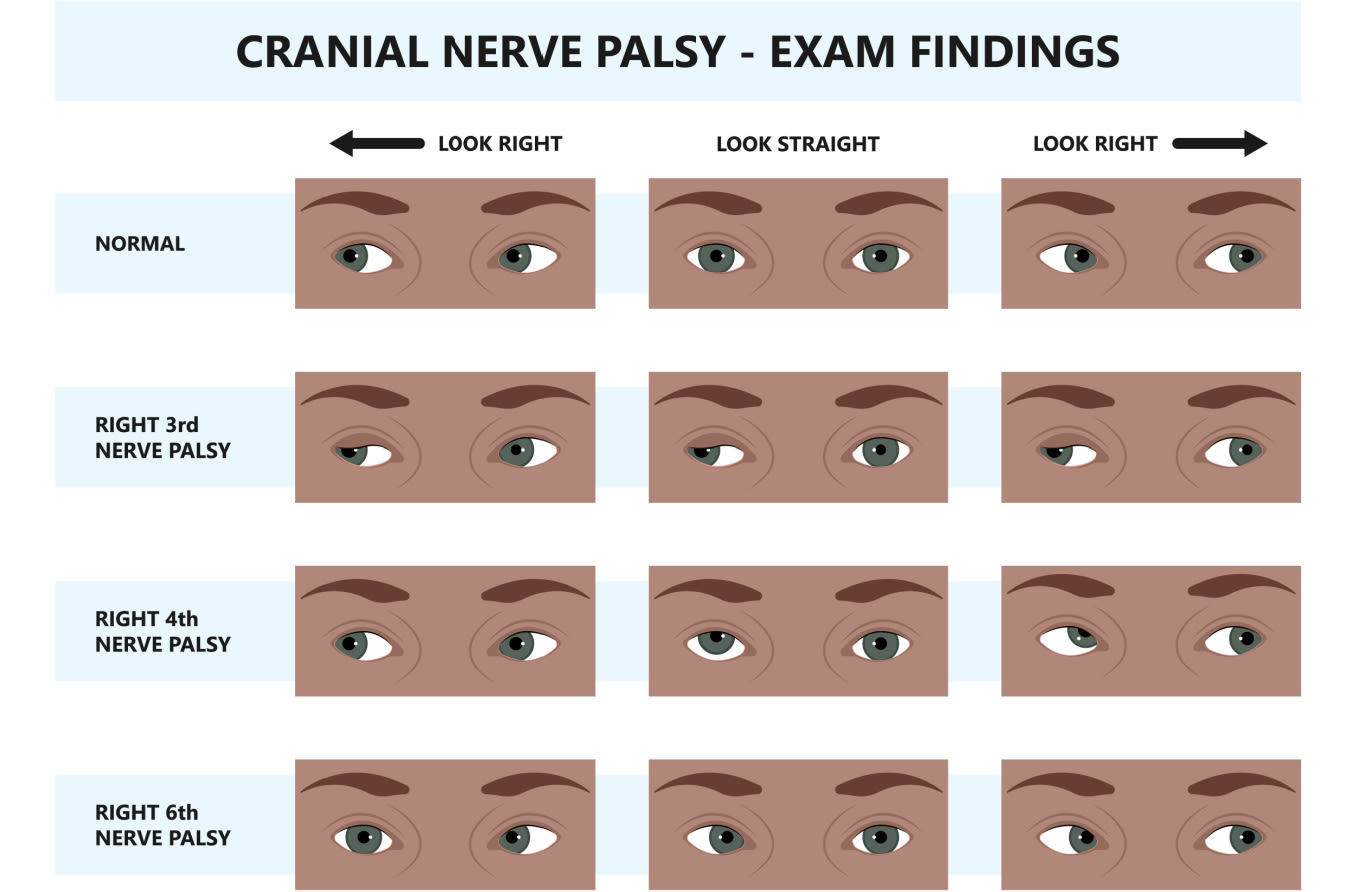 Cranial nerve palsy exam findings examples
