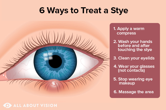 How To Get Rid Of A Stye Stye Treatments And Remedies