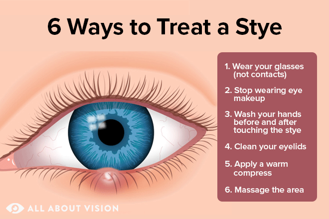 What Is a Stye (Sty) in the Eye?