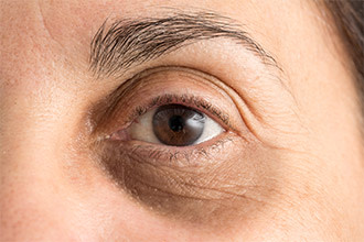 Puffy eyes: What to do about puffy eyes and dark circles