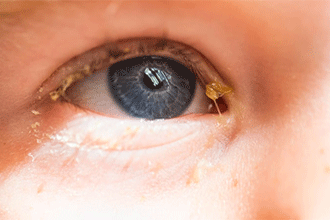 Types of Eye Mucus, Discharge, and Boogers