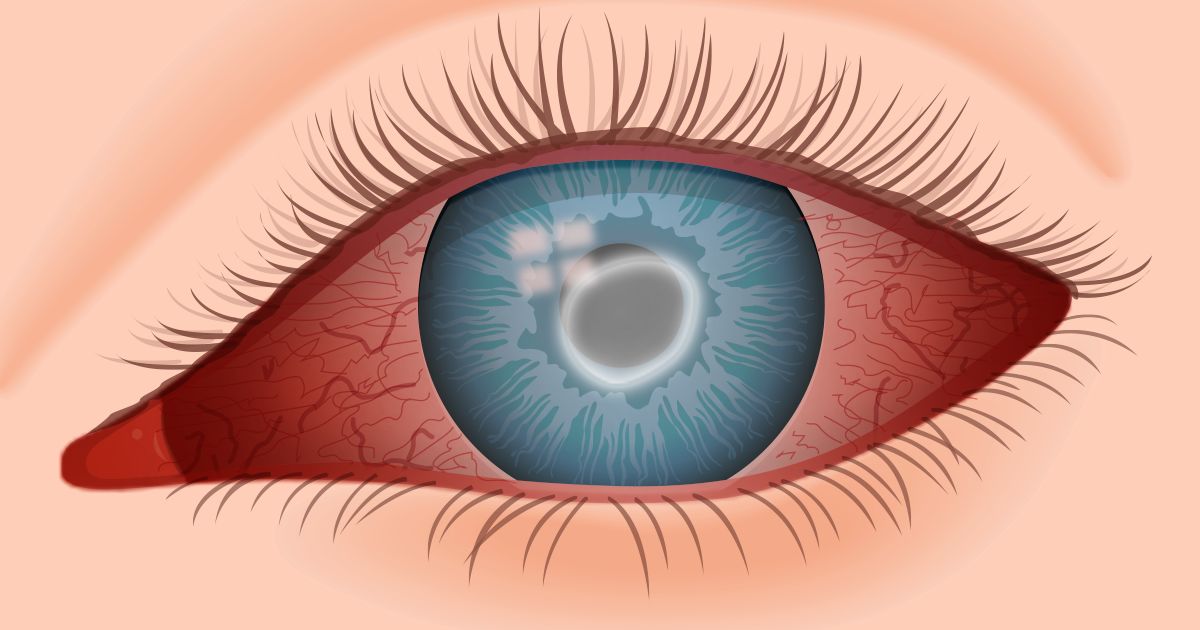 illustration de la kératite à Acanthamoeba