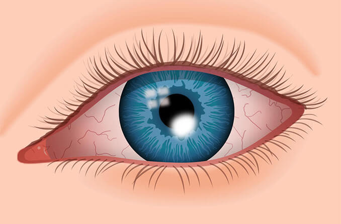 Illustration de l'oeil avec ulcère cornéen