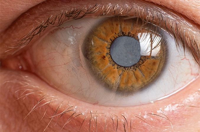 What Do Cataracts Look Like?